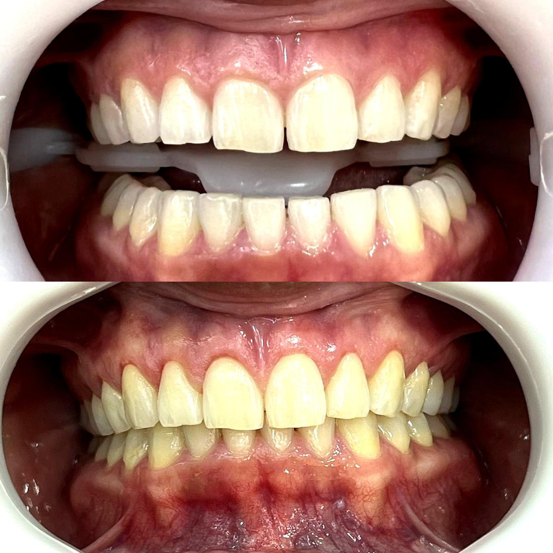 Gengivoplastia