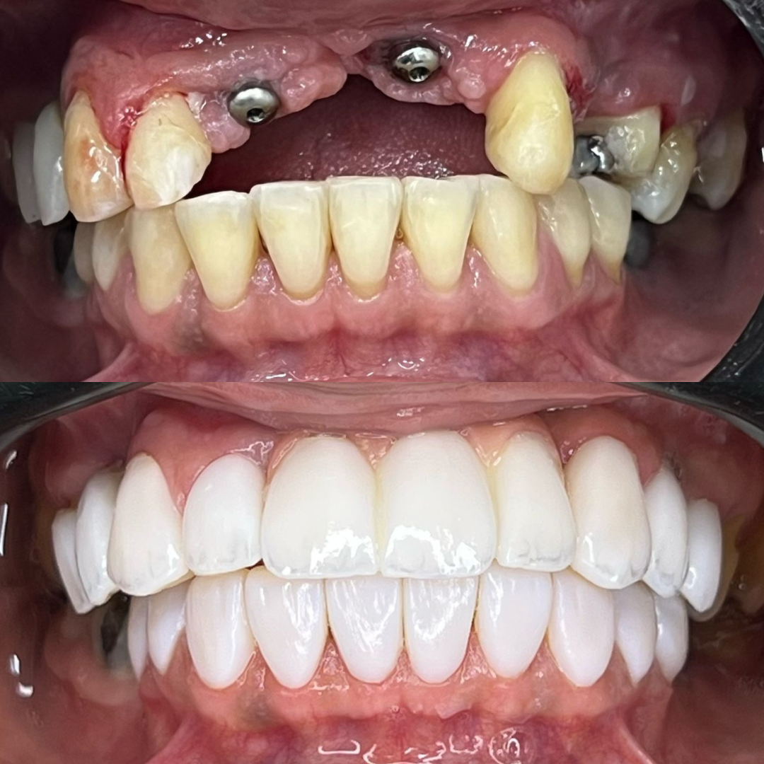 Implantes 1x1